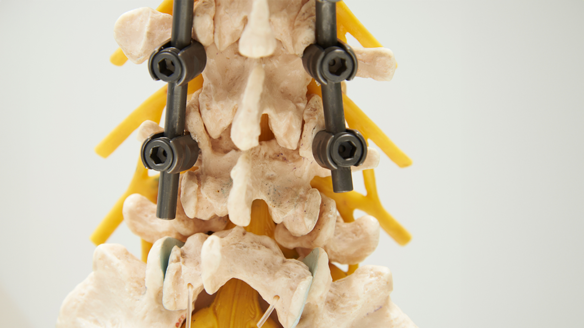 Endoscopic TLIF detailed medical procedure