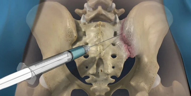 Sacroiliac Joint Injections detailed medical procedure