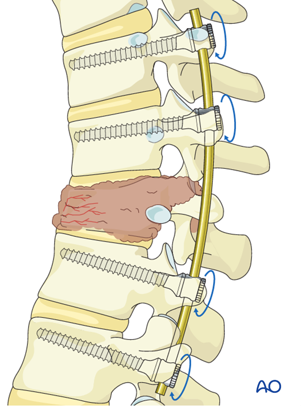 Posterior Spine Stabilization detailed medical procedure